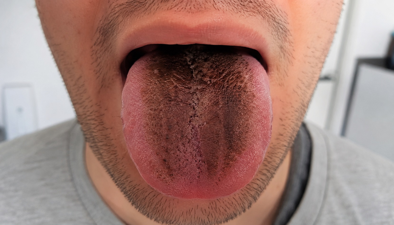 Langue noire et villeuse : causes, symptômes et traitements